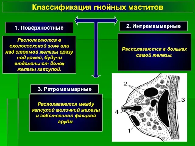 Классификация гнойных маститов Располагаются в околососковой зоне или над стромой железы