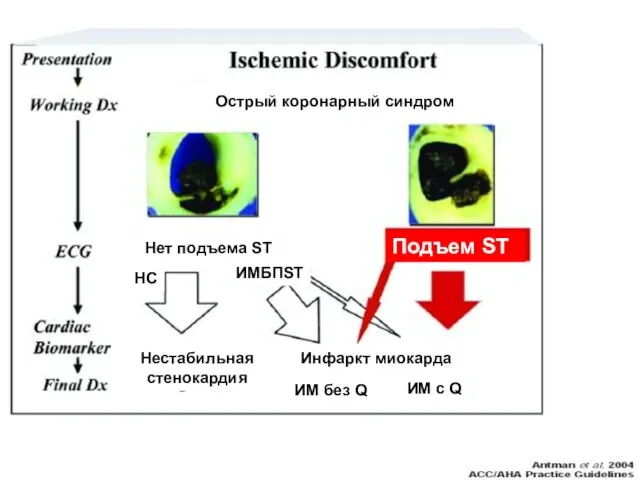 Острый коронарный синдром Нет подъема ST Подъем ST НС ИМБПST Нестабильная