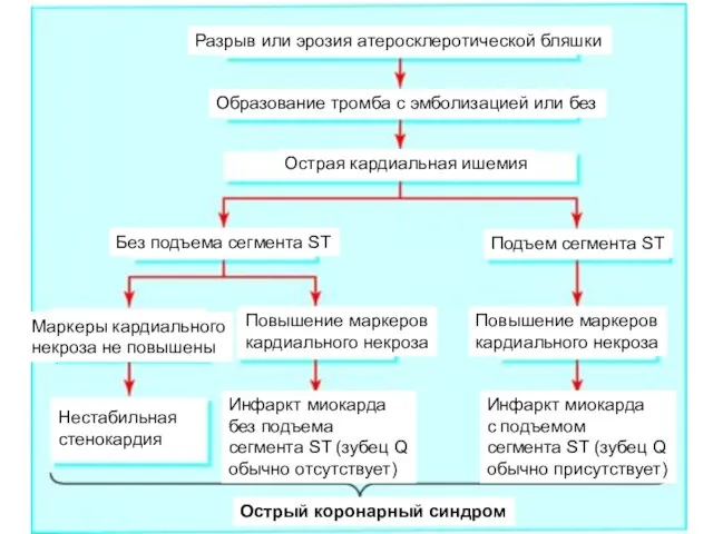 Разрыв или эрозия атеросклеротической бляшки Образование тромба с эмболизацией или без