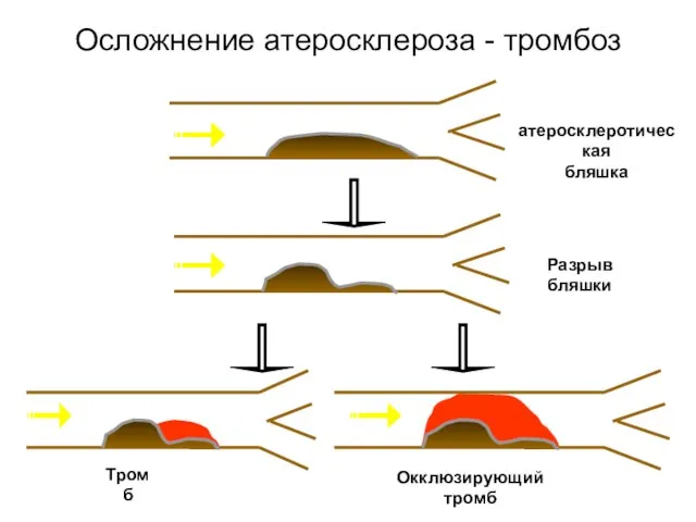 Осложнение атеросклероза - тромбоз атеросклеротическая бляшка Разрыв бляшки Тромб Окклюзирующий тромб