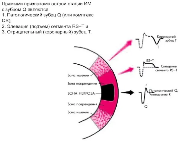 Прямыми признаками острой стадии ИМ с зубцом Q являются: 1. Патологический