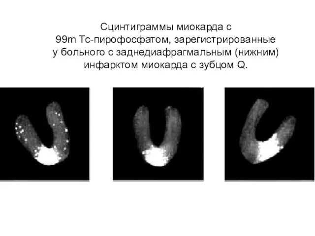 Сцинтиграммы миокарда с 99m Тс-пирофосфатом, зарегистрированные у больного с заднедиафрагмальным (нижним) инфарктом миокарда с зубцом Q.