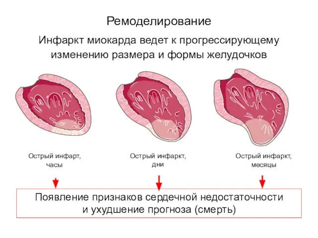 Инфаркт миокарда ведет к прогрессирующему изменению размера и формы желудочков Ремоделирование