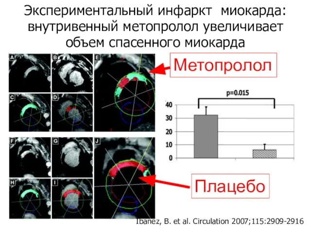 Ibanez, B. et al. Circulation 2007;115:2909-2916 Экспериментальный инфаркт миокарда: внутривенный метопролол