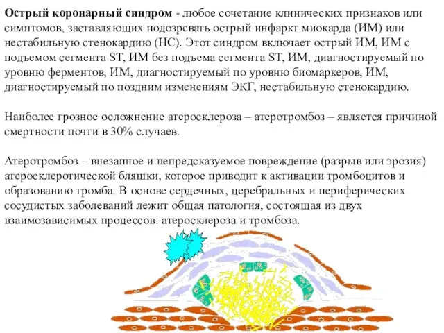 Острый коронарный синдром - любое сочетание клинических признаков или симптомов, заставляющих