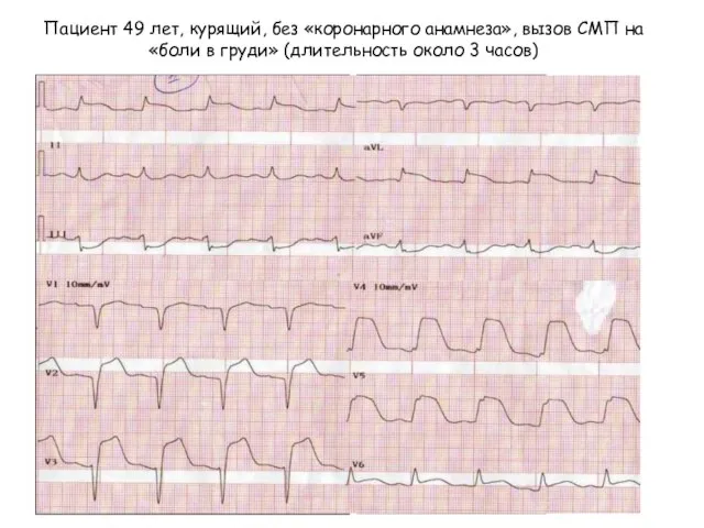 Пациент 49 лет, курящий, без «коронарного анамнеза», вызов СМП на «боли