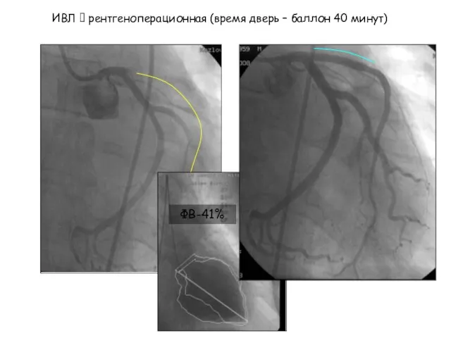 ИВЛ ? рентгеноперационная (время дверь – баллон 40 минут) ФВ-41%