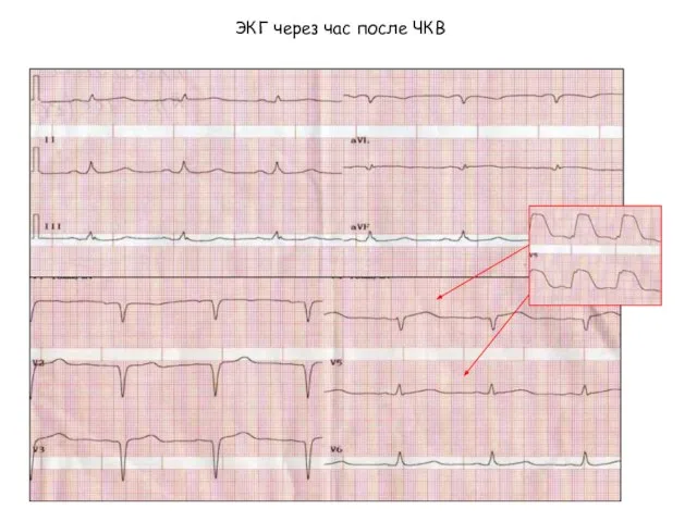 ЭКГ через час после ЧКВ