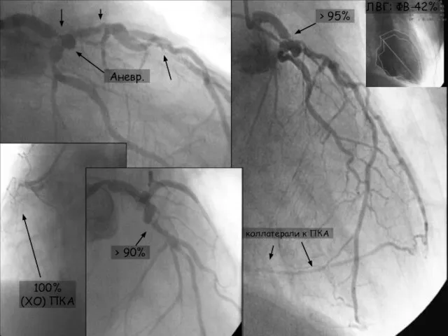 ПКА коллатерали к ПКА ЛВГ: ФВ-42% 100% (ХО) ПКА Аневр. > 95% > 90%