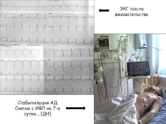 Стабилизация АД Снятие с ИВЛ на 7-е сутки… (ДН) ЭКГ после вмешательства