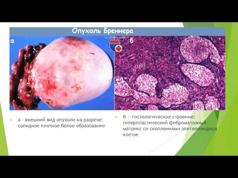 а - внешний вид опухоли на разрезе: солидное плотное белое образование