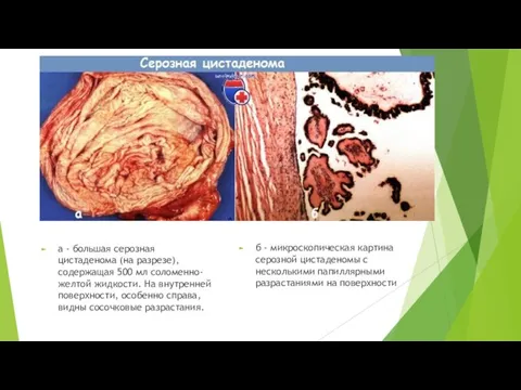 а - большая серозная цистаденома (на разрезе), содержащая 500 мл соломенно-желтой