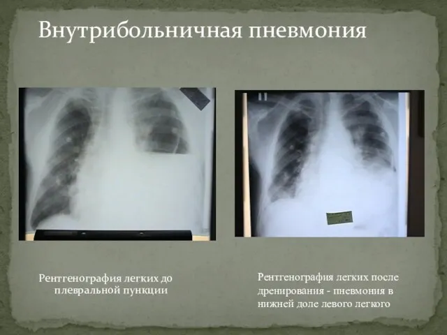 Внутрибольничная пневмония Рентгенография легких до плевральной пункции Рентгенография легких после дренирования