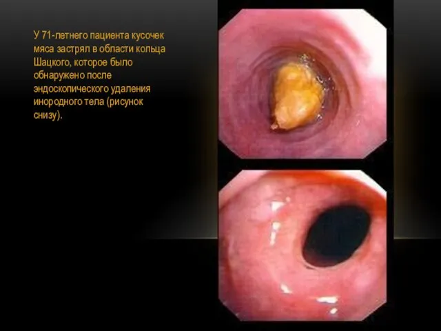У 71-летнего пациента кусочек мяса застрял в области кольца Шацкого, которое