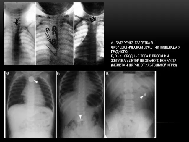 А - БАТАРЕЙКА-ТАБЛЕТКА В I ФИЗИОЛОГИЧЕСКОМ СУЖЕНИИ ПИЩЕВОДА У ГРУДНОГО, Б,