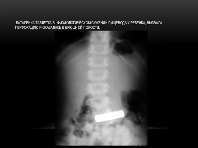 БАТАРЕЙКА-ТАБЛЕТКА В I ФИЗИОЛОГИЧЕСКОМ СУЖЕНИИ ПИЩЕВОДА У РЕБЕНКА, ВЫЗВАЛА ПЕРФОРАЦИЮ И ОКАЗАЛАСЬ В БРЮШНОЙ ПОЛОСТИ.