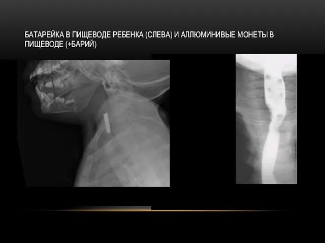БАТАРЕЙКА В ПИЩЕВОДЕ РЕБЕНКА (СЛЕВА) И АЛЛЮМИНИВЫЕ МОНЕТЫ В ПИЩЕВОДЕ (+БАРИЙ)