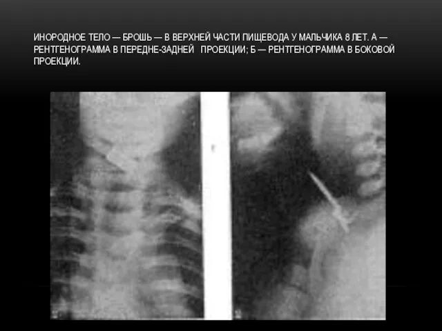 ИНОРОДНОЕ ТЕЛО — БРОШЬ — В ВЕРХНЕЙ ЧАСТИ ПИЩЕВОДА У МАЛЬЧИКА