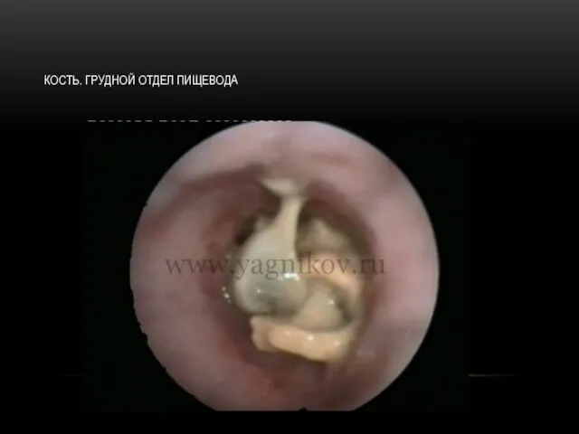 КОСТЬ. ГРУДНОЙ ОТДЕЛ ПИЩЕВОДА