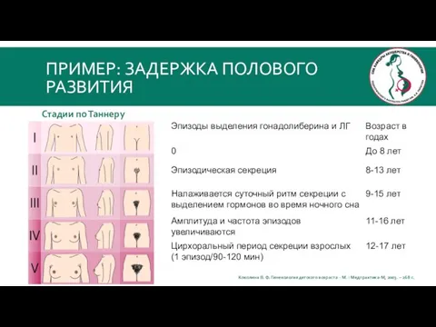 ПРИМЕР: ЗАДЕРЖКА ПОЛОВОГО РАЗВИТИЯ Коколина В. Ф. Гинекология детского возраста -