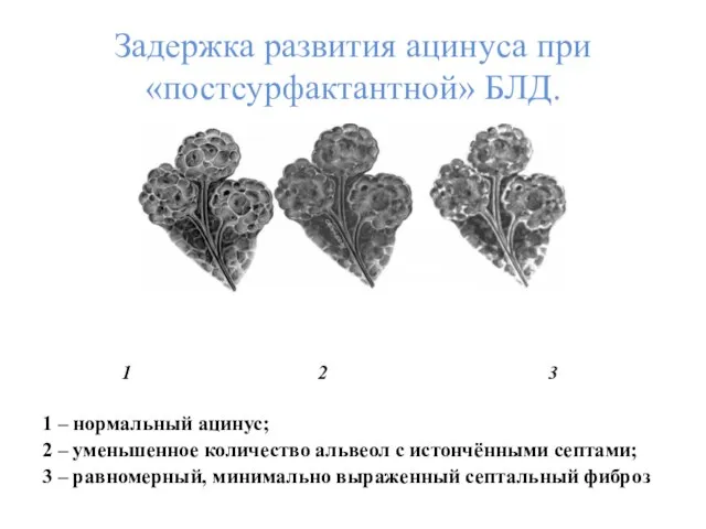 Задержка развития ацинуса при «постсурфактантной» БЛД. 1 2 3 1 –