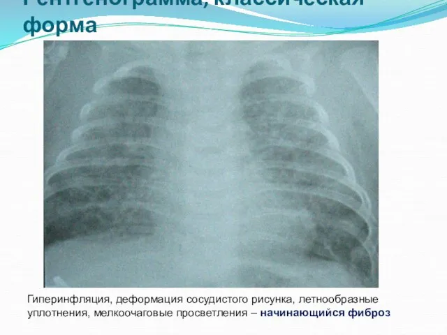 Гиперинфляция, деформация сосудистого рисунка, летнообразные уплотнения, мелкоочаговые просветления – начинающийся фиброз Рентгенограмма, классическая форма
