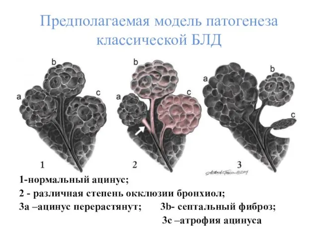 Предполагаемая модель патогенеза классической БЛД 1-нормальный ацинус; 2 - различная степень