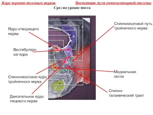 Срез на уровне моста Ядра черепно-мозговых нервов Ядро отводящего нерва Вестибулярные