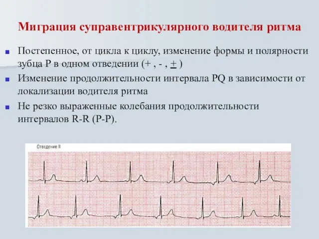 Миграция суправентрикулярного водителя ритма Постепенное, от цикла к циклу, изменение формы