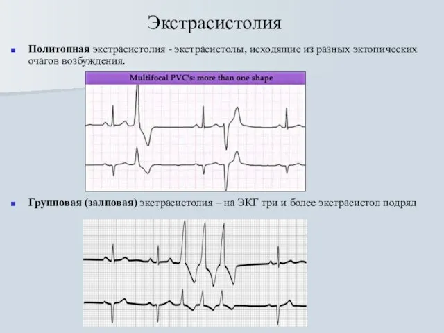 Экстрасистолия Политопная экстрасистолия - экстрасистолы, исходящие из разных эктопических очагов возбуждения.