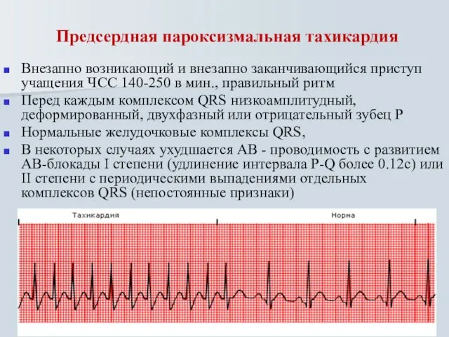 Предсердная пароксизмальная тахикардия Внезапно возникающий и внезапно заканчивающийся приступ учащения ЧСС