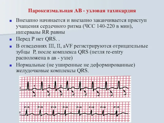 Пароксизмальная АВ - узловая тахикардия Внезапно начинается и внезапно заканчивается приступ