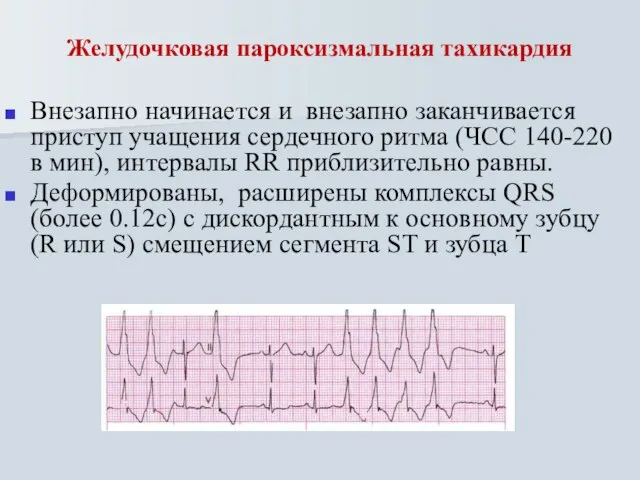 Желудочковая пароксизмальная тахикардия Внезапно начинается и внезапно заканчивается приступ учащения сердечного