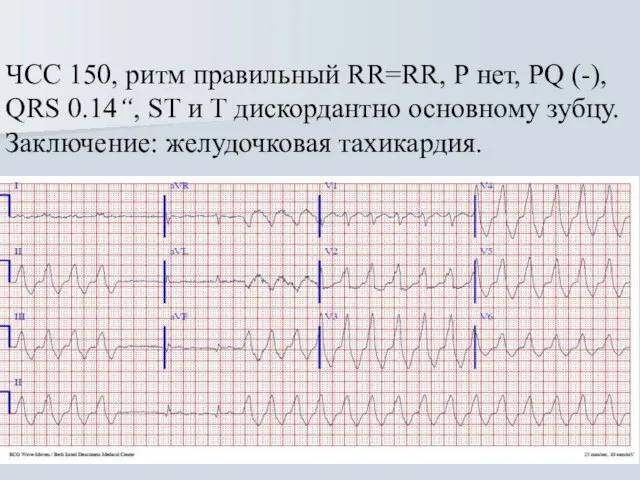 ЧСС 150, ритм правильный RR=RR, Р нет, PQ (-), QRS 0.14“,