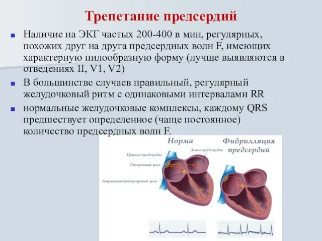 Трепетание предсердий Наличие на ЭКГ частых 200-400 в мин, регулярных, похожих