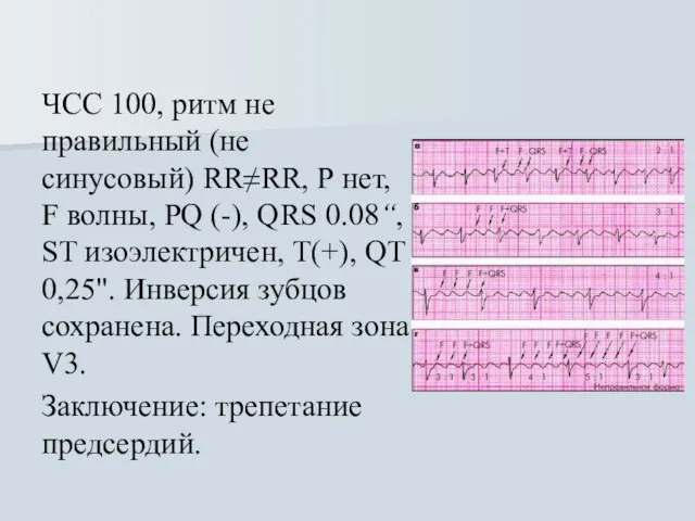 ЧСС 100, ритм не правильный (не синусовый) RR≠RR, Р нет, F