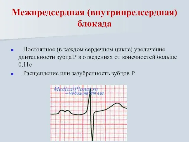 Межпредсердная (внутрипредсердная) блокада Постоянное (в каждом сердечном цикле) увеличение длительности зубца