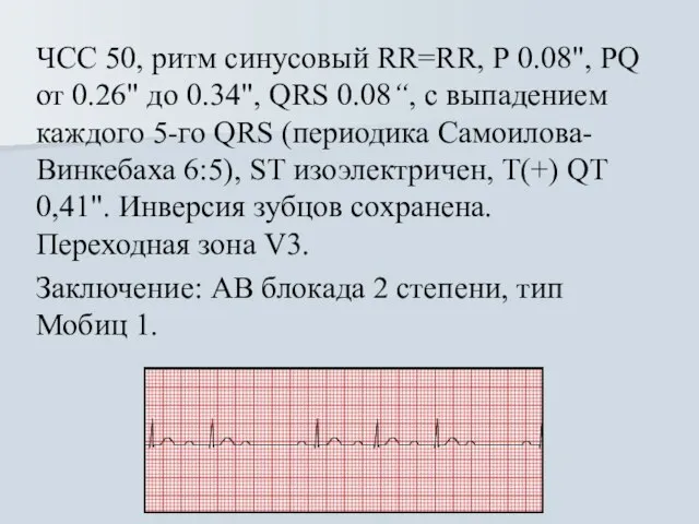 ЧСС 50, ритм синусовый RR=RR, Р 0.08", PQ от 0.26" до