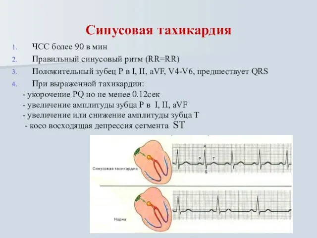 Синусовая тахикардия ЧСС более 90 в мин Правильный синусовый ритм (RR=RR)