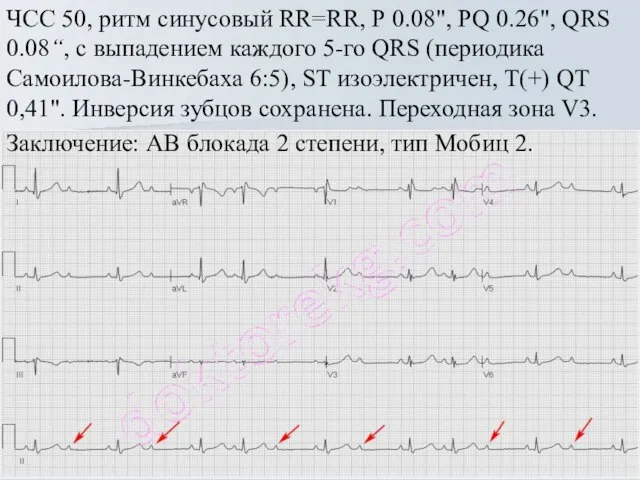 ЧСС 50, ритм синусовый RR=RR, Р 0.08", PQ 0.26", QRS 0.08“,