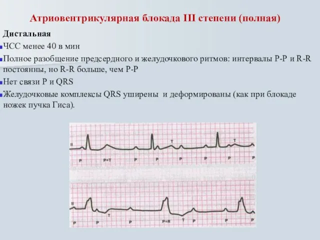 Атриовентрикулярная блокада III степени (полная) Дистальная ЧСС менее 40 в мин