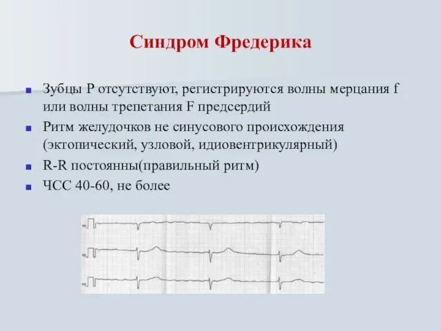 Синдром Фредерика Зубцы Р отсутствуют, регистрируются волны мерцания f или волны