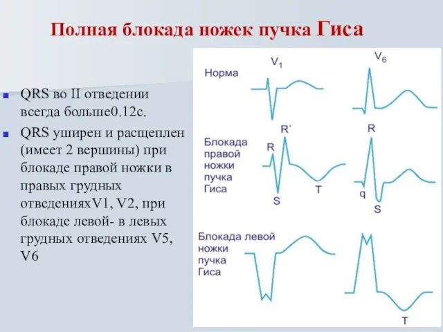 Полная блокада ножек пучка Гиса QRS во II отведении всегда больше0.12с.