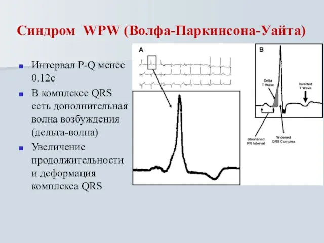 Синдром WPW (Волфа-Паркинсона-Уайта) Интервал P-Q менее 0.12с В комплексе QRS есть