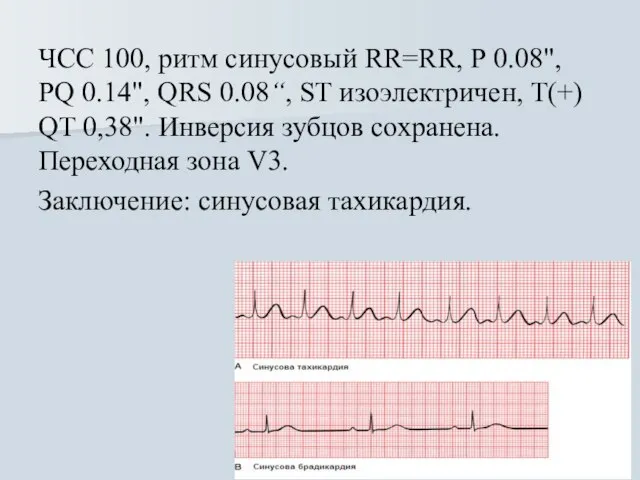 ЧСС 100, ритм синусовый RR=RR, Р 0.08", PQ 0.14", QRS 0.08“,