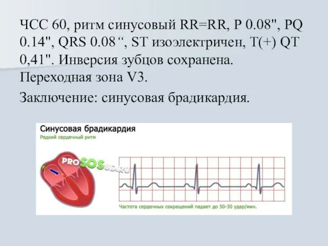 ЧСС 60, ритм синусовый RR=RR, Р 0.08", PQ 0.14", QRS 0.08“,