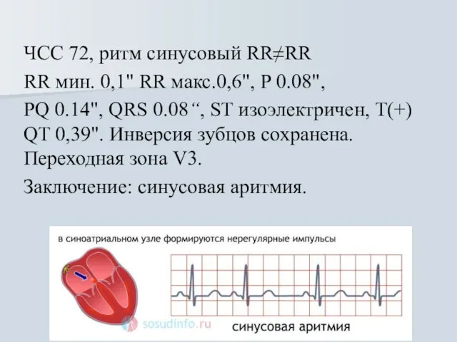 ЧСС 72, ритм синусовый RR≠RR RR мин. 0,1" RR макс.0,6", Р