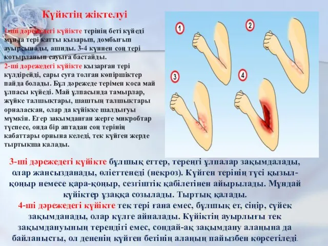 1-ші дәрежедегі күйікте терінің беті күйеді мұнда тері қатты қызарып, домбығып