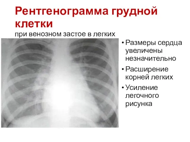 Рентгенограмма грудной клетки при венозном застое в легких Размеры сердца увеличены