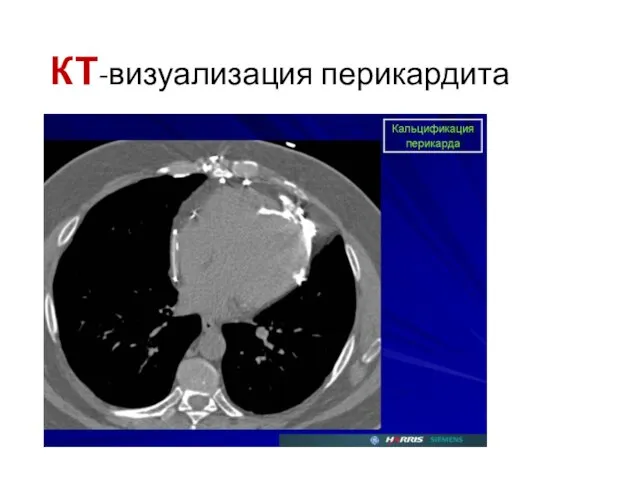 КТ-визуализация перикардита